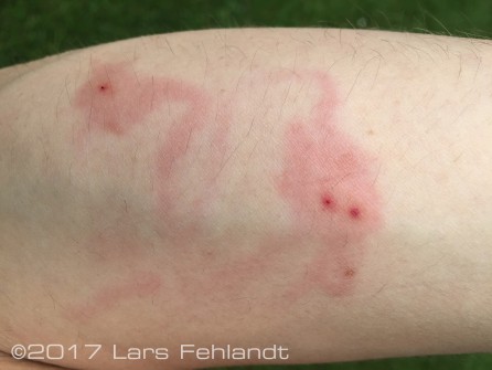infected insect bite
